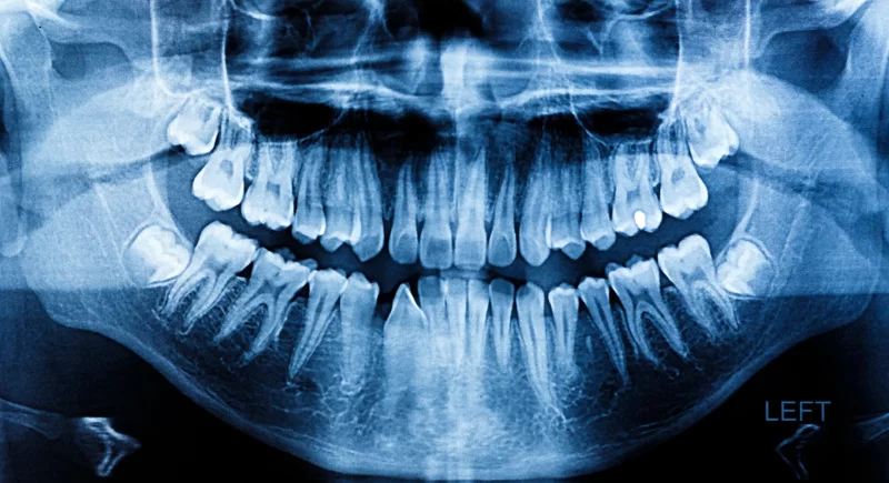 OPG X-Ray in OMR