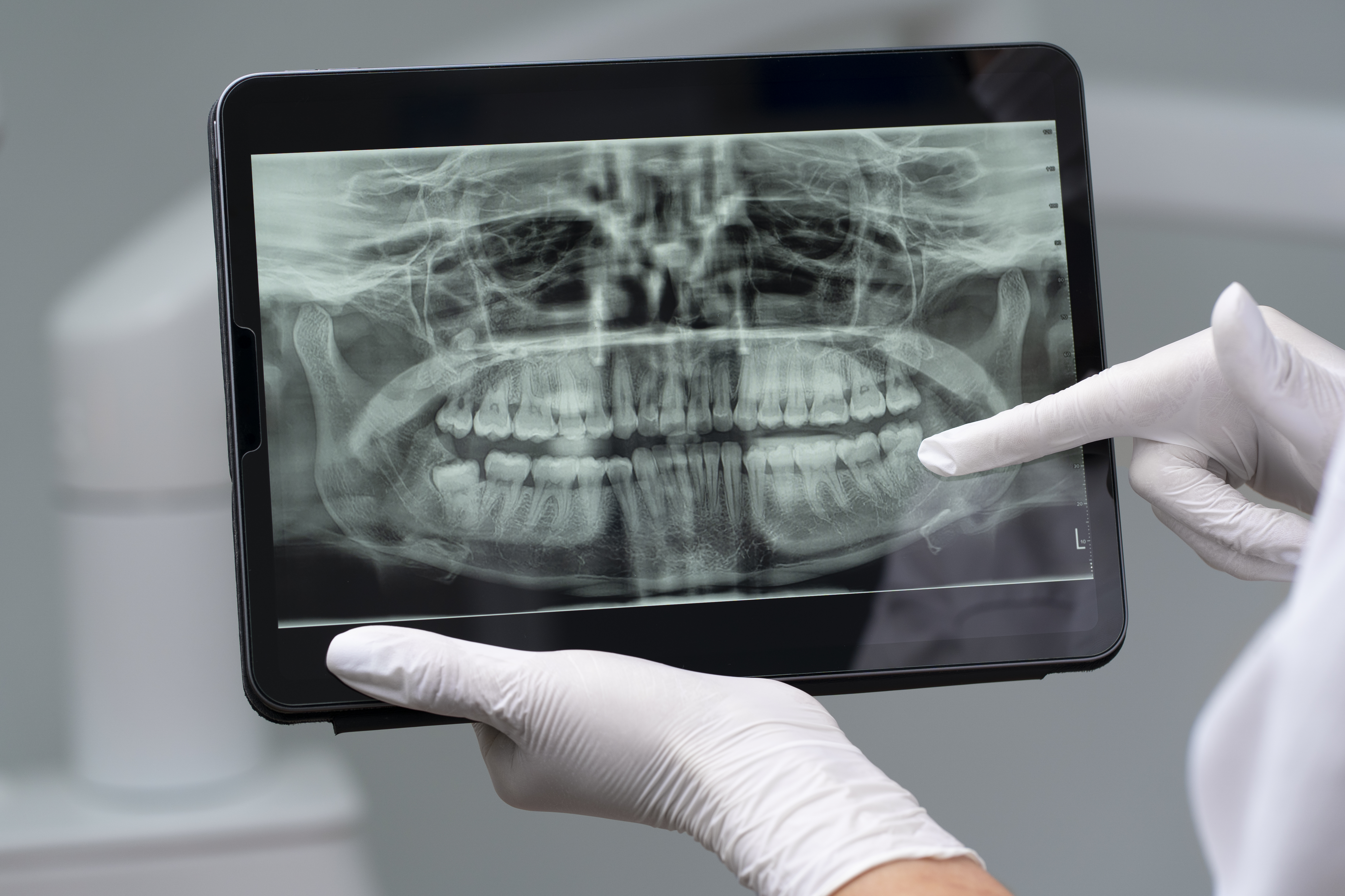 OPG X-Ray in OMR