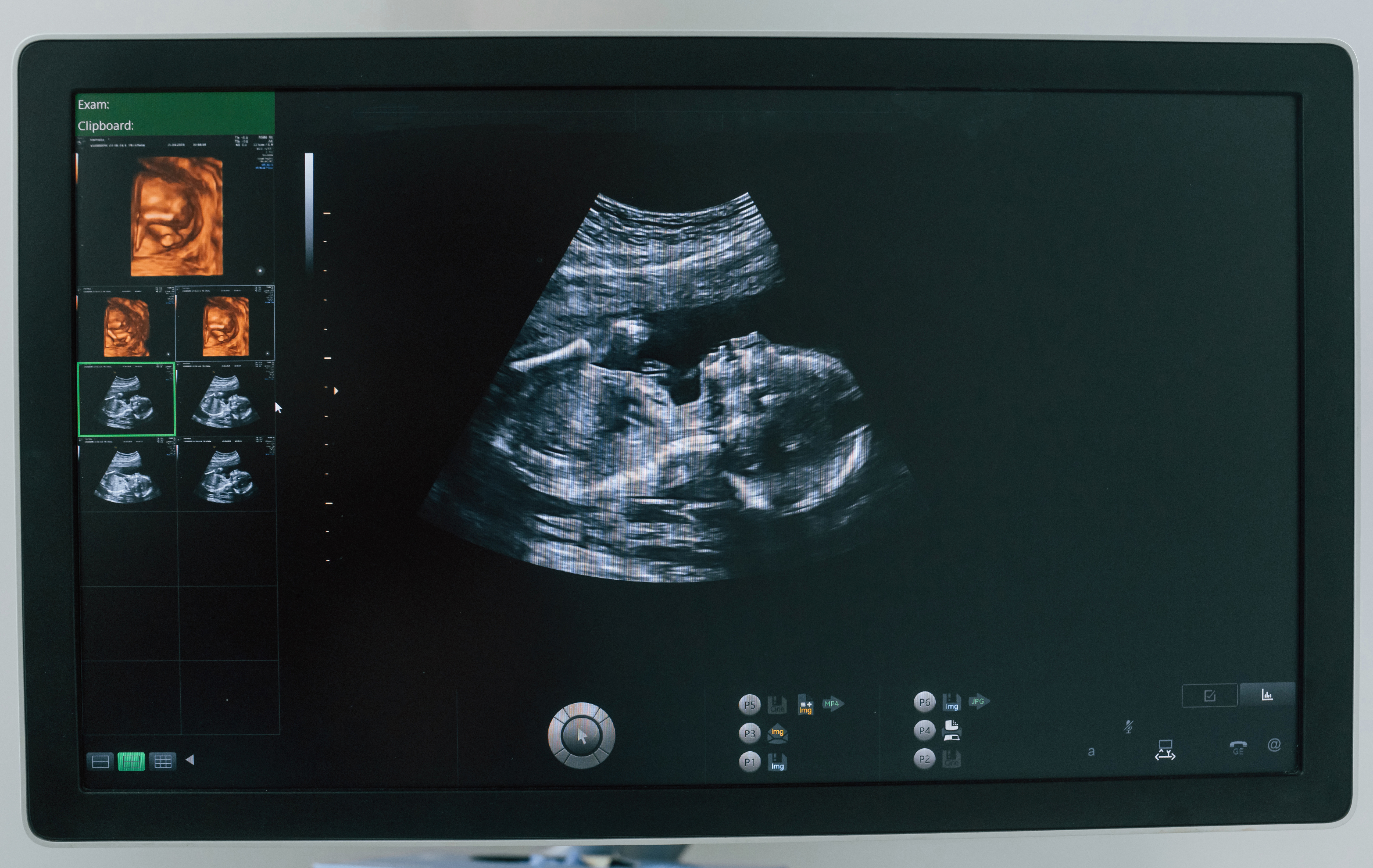 3D/4D Obstetric Scan in Padur